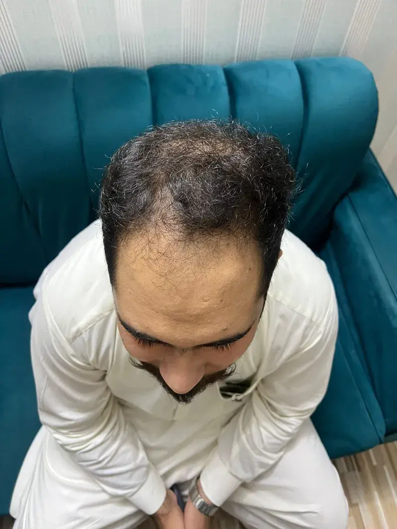 Before Chinese hair treatment — patient case case-chinese-2400-norwood-iv